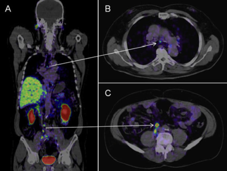 AI prostate cancer detection